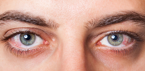 What Is An Eye Stroke