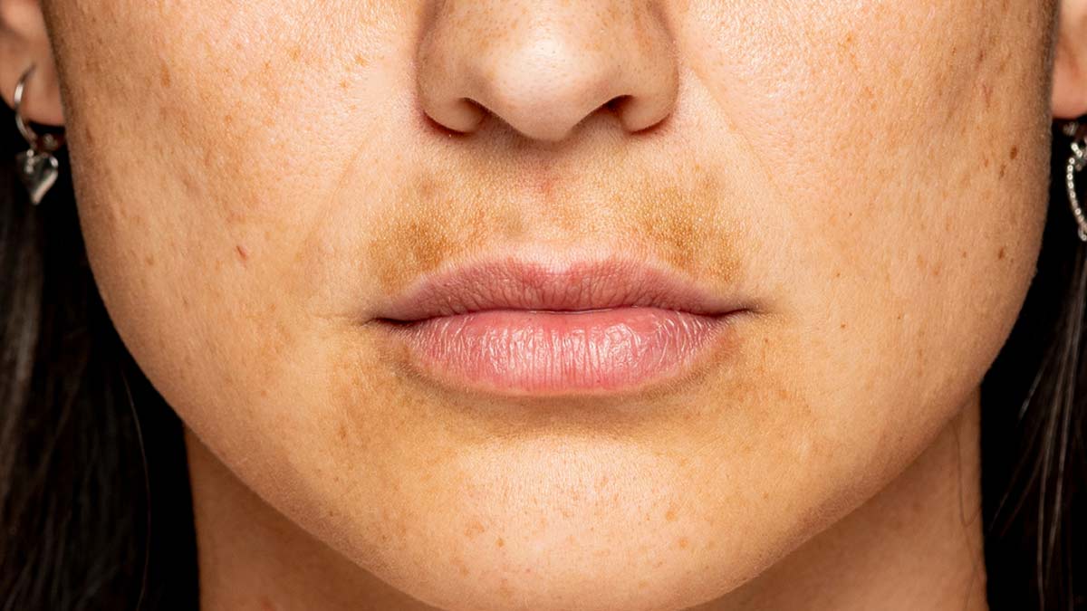 how to solve pigmentation problem