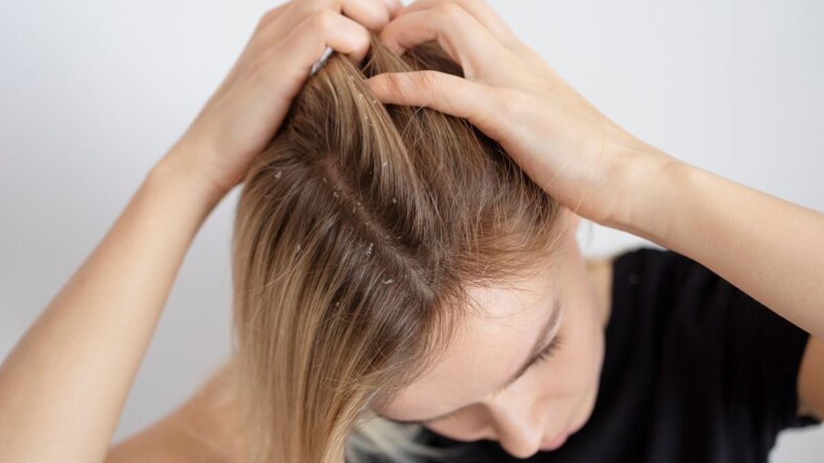 Scalp Problems: உச்சந்தலையில் ஏற்படும் பூஞ்சை தொற்றை குறைக்க செய்யும் செம்பருத்திப் பூ மற்றும் சுரைக்காய்