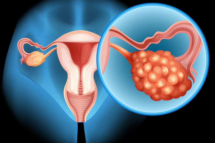 Ovarian Cancer