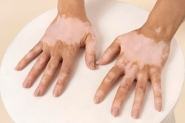 white spots on skin
