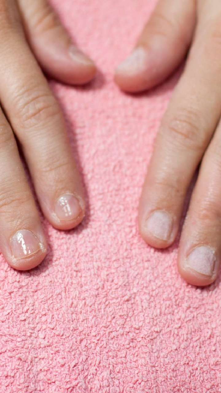Premium Photo | White spot on the womans fingernail revealed about the  health caused by calcium deficiency