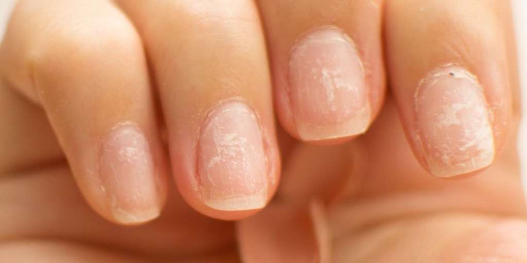 5-diseases-that-white-patches-on-your-nails-might-indicate-herzindagi