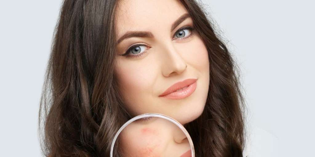 Skincare Routine DIY Face Packs For Acne Prone Skin