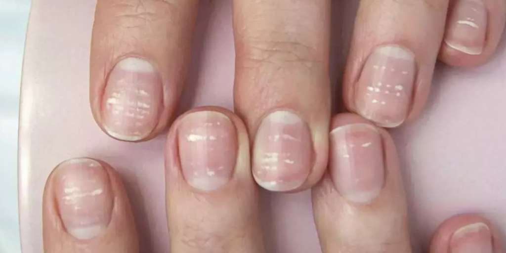 Vitamin deficiency symptoms: Are white spots on nails a sign? Doctor says  'stop worrying' | Express.co.uk