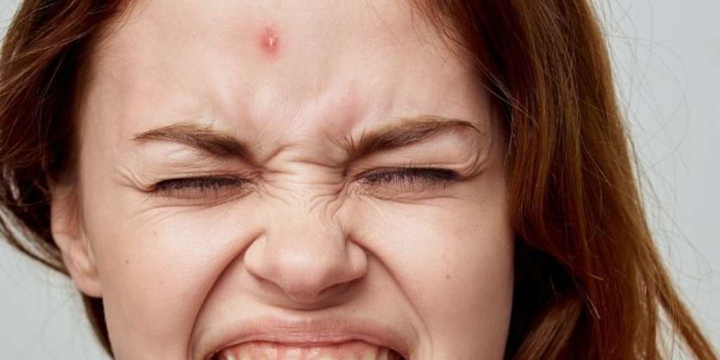 6 Tips To Remove Forehead Pimples Naturally At Home