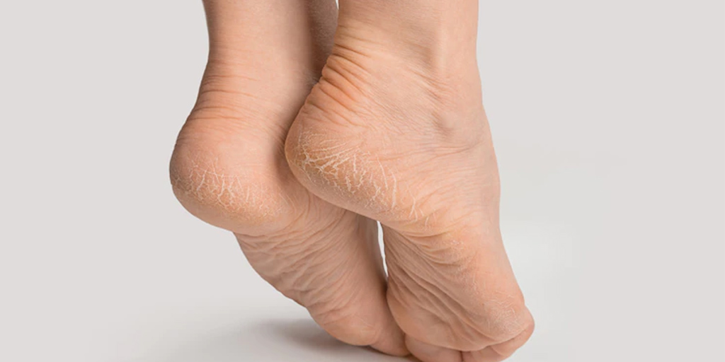 Dr. Scholl's Cracked Heel Repair Balm (2.5oz) 25% Urea. Heals and  Moisturizes feet - Walmart.com