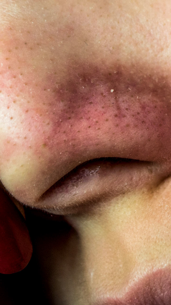 1675067517-blackheads-removal.jpg